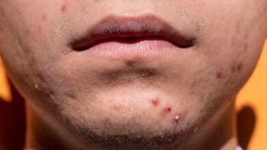 Como decidir qual tratamento de pele para acne é para você