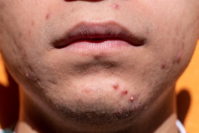 Como decidir qual tratamento de pele para acne é para você